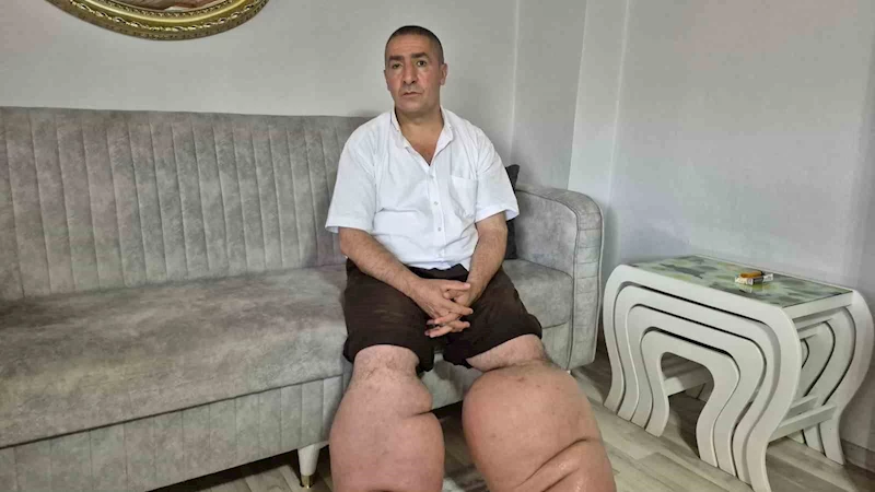 15 yıldır fil hastalığıyla mücadele ediyor
